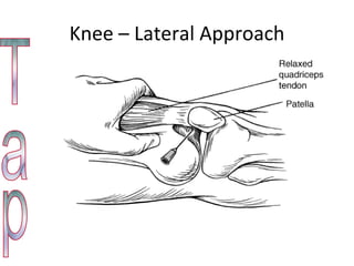 Knee – Lateral Approach Tap 