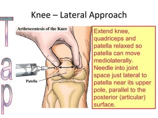 Knee – Lateral Approach Extend knee, quadriceps and patella relaxed so patella can move mediolaterally. Needle into joint space just lateral to patella near its upper pole, parallel to the posterior (articular) surface.  Tap 