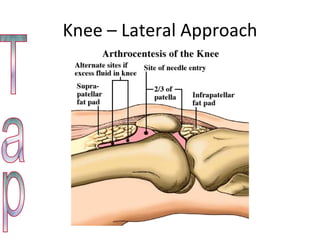 Knee – Lateral Approach Tap 