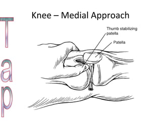 Knee – Medial Approach Tap 