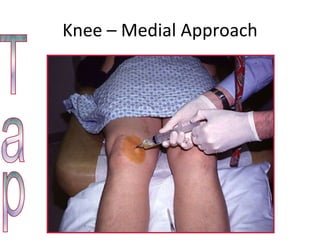 Knee – Medial Approach Tap 