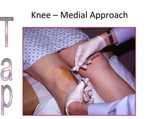 Knee – Medial Approach Tap 