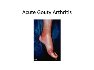 Acute Gouty Arthritis 