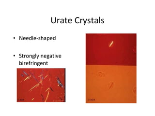 Urate Crystals Needle-shaped Strongly negative birefringent 