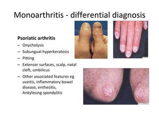Monoarthritis - differential diagnosis Psoriatic arthritis Onycholysis Subungual hyperkeratosis Pitting Extensor surfaces, scalp, natal cleft, umbilicus Other associated features eg uveitis, inflammatory bowel disease, enthesitis, Ankylosing spondylitis 