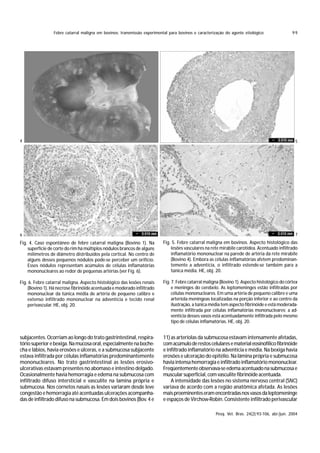 Febre catarral maligna em bovinos: transmissão experimental para bovinos e caracterização do agente etiológico                 99




4                                                                                                                                                5




6                                                                                                                                                7
Fig. 4. Caso espontâneo de febre catarral maligna (Bovino 1). Na          Fig. 5. Febre catarral maligna em bovinos. Aspecto histológico das
    superfície de corte do rim há múltiplos nódulos brancos de alguns         lesões vasculares na rete mirabile carotídea. Acentuado infiltrado
    milímetros de diâmetro distribuídos pela cortical. No centro de           inflamatório mononuclear na parede de artéria da rete mirabile
    alguns desses pequenos nódulos pode-se perceber um orifício.              (Bovino 4). Embora as células inflamatórias afetem predominan-
    Esses nódulos representam acúmulos de células inflamatórias               temente a adventícia, o infiltrado estende-se também para a
    mononucleares ao redor de pequenas artérias (ver Fig. 6).                 túnica média. HE, obj. 20.

Fig. 6. Febre catarral maligna. Aspecto histológico das lesões renais     Fig. 7. Febre catarral maligna (Bovino 1). Aspecto histológico do córtex
    (Bovino 1). Há necrose fibrinóide acentuada e moderado infiltrado          e meninges do cerebelo. As leptomeninges estão infiltradas por
    mononuclear da túnica média de artéria de pequeno calibre e                células mononucleares. Em uma artéria de pequeno calibre e uma
    extenso infiltrado mononuclear na adventícia e tecido renal                arteríola meníngeas localizadas na porção inferior e ao centro da
    perivascular. HE, obj. 20.                                                 ilustração, a túnica média tem aspecto fibrinóide e está moderada-
                                                                               mente infiltrada por células inflamatórias mononucleares; a ad-
                                                                               ventícia desses vasos está acentuadamente infiltrada pelo mesmo
                                                                               tipo de células inflamatórias. HE, obj. 20.


subjacentes. Ocorriam ao longo do trato gastrintestinal, respira-         11) as arteríolas da submucosa estavam intensamente afetadas,
tório superior e bexiga. Na mucosa oral, especialmente na boche-          com acúmulo de restos celulares e material eosinofílico fibrinóide
cha e lábios, havia erosões e úlceras, e a submucosa subjacente           e infiltrado inflamatório na adventícia e média. Na bexiga havia
estava infiltrada por células inflamatórias predominantemente             erosões e ulceração do epitélio. Na lâmina própria e submucosa
mononucleares. No trato gastrintestinal as lesões erosivo-                havia intensa hemorragia e infiltrado inflamatório mononuclear.
ulcerativas estavam presentes no abomaso e intestino delgado.             Freqüentemente observava-se edema acentuado na submucosa e
Ocasionalmente havia hemorragia e edema na submucosa com                  muscular superficial, com vasculite fibrinóide acentuada.
infiltrado difuso intersticial e vasculite na lamina própria e                A intensidade das lesões no sistema nervoso central (SNC)
submucosa. Nos cornetos nasais as lesões variaram desde leve              variava de acordo com a região anatômica afetada. As lesões
congestão e hemorragia até acentuadas ulcerações acompanha-               mais proeminentes eram encontradas nos vasos da leptomeninge
das de infiltrado difuso na submucosa. Em dois bovinos (Bov. 4 e          e espaços de Virchow-Robin. Consistente infiltrado perivascular

                                                                                                      Pesq. Vet. Bras. 24(2):93-106, abr./jun. 2004
 