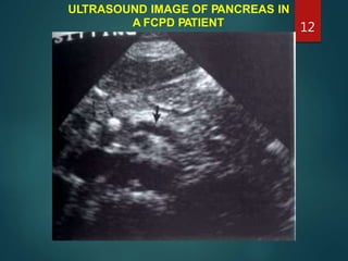 ULTRASOUND IMAGE OF PANCREAS IN
A FCPD PATIENT 12
 