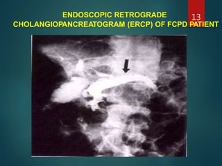ENDOSCOPIC RETROGRADE
CHOLANGIOPANCREATOGRAM (ERCP) OF FCPD PATIENT
13
 