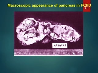 Macroscopic appearance of pancreas in FCPD
14
 