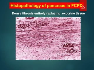 Histopathology of pancreas in FCPD
Dense fibrosis entirely replacing exocrine tissue
15
 