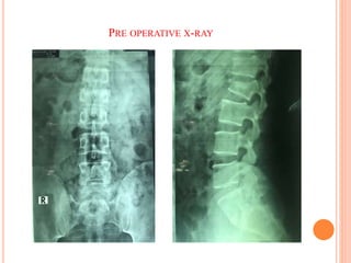 PRE OPERATIVE X-RAY
 