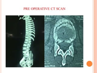 PRE OPERATIVE CT SCAN
 