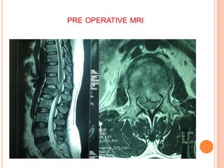PRE OPERATIVE MRI
 
