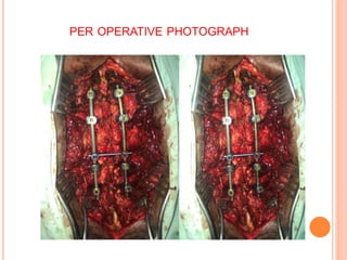 PER OPERATIVE PHOTOGRAPH
 