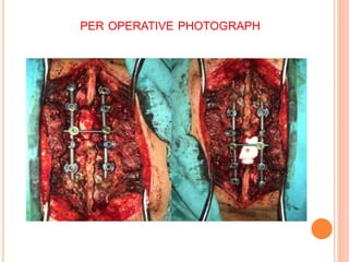 PER OPERATIVE PHOTOGRAPH
 