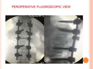 PEROPERATIVE FLUOROSCOPIC VIEW
 