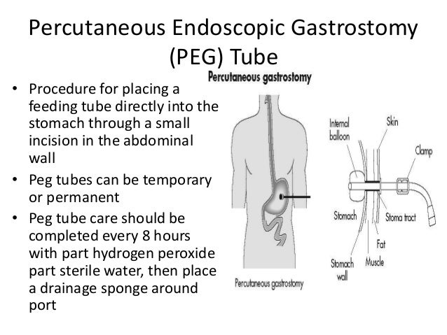 What is a percutaneous endoscopic gastrostomy?