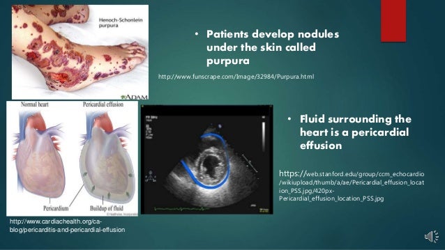 Physiological Effects Of Rheumatoid Arthritis
