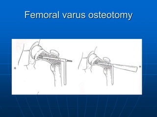 Femoral varus osteotomy
 
