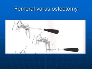 Femoral varus osteotomy
 