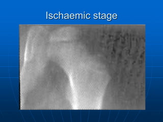 Ischaemic stage
 