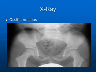 X-Ray
 Ossific nucleus
smaller
 