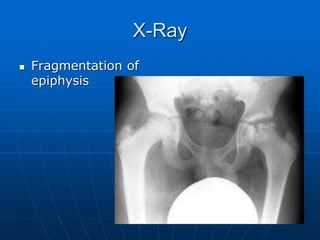 X-Ray
 Fragmentation of
epiphysis
 