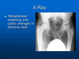 X-Ray
 Metaphyseal
widening and
cystic changes in
femoral neck
 