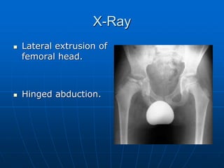 X-Ray
 Lateral extrusion of
femoral head.
 Hinged abduction.
 
