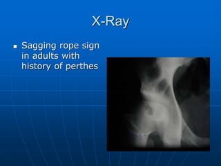 X-Ray
 Sagging rope sign
in adults with
history of perthes
 