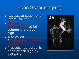 Bone Scan( stage 2)
 Revascularisation of a
lateral column
 Failure to
revascularise at lat
column is a grave
sign
 Also called
“scintigraphic head at
risk sign”
 Precedes radiographic
head at risk sign by
2-3 mths
 