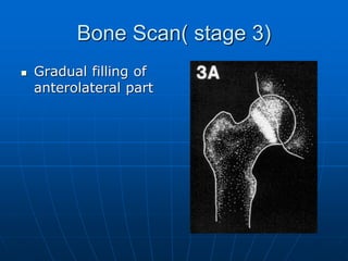 Bone Scan( stage 3)
 Gradual filling of
anterolateral part
 
