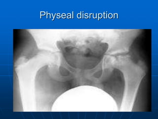 Physeal disruption
 