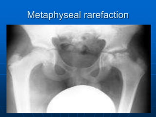 Metaphyseal rarefaction
 