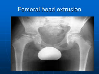Femoral head extrusion
 