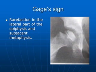 Gage’s sign
 Rarefaction in the
lateral part of the
epiphysis and
subjacent
metaphysis.
 