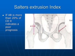 Salters extrusion Index
 If AB is more
than 20% of
CD it
indicates a
poor
prognosis
 