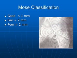 Mose Classification
 Good < 1 mm
 Fair < 2 mm
 Poor > 2 mm
 