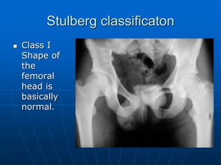 Stulberg classificaton
 Class I
Shape of
the
femoral
head is
basically
normal.
 