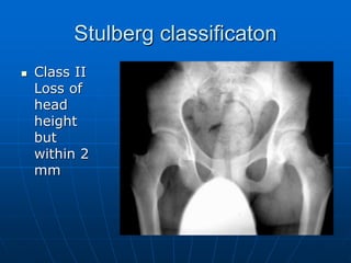 Stulberg classificaton
 Class II
Loss of
head
height
but
within 2
mm
 