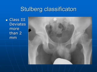 Stulberg classificaton
 Class III
Deviates
more
than 2
mm
 