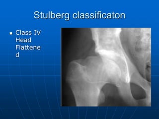Stulberg classificaton
 Class IV
Head
Flattene
d
 