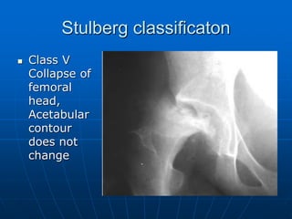 Stulberg classificaton
 Class V
Collapse of
femoral
head,
Acetabular
contour
does not
change
 