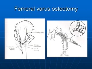 Femoral varus osteotomy
 