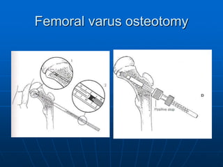 Femoral varus osteotomy
 