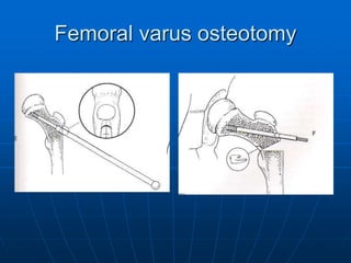 Femoral varus osteotomy
 