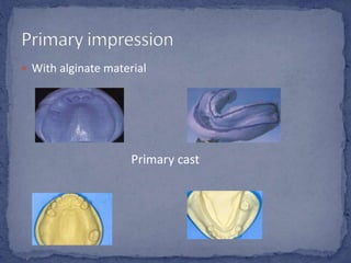  With alginate material
Primary cast
 