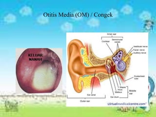 Otitis Media (OM) / Congek
 