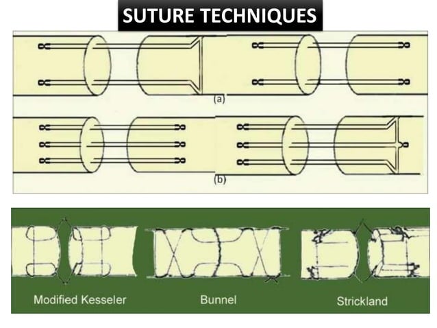 Brunner Incision Han FDP FDS repair.pdf