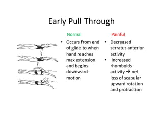 Early Pull Through
• Occurs from end
of glide to when
hand reaches
max extension
and begins
downward
motion
Normal Painful
• Decreased
serratus anterior
activity
• Increased
rhomboids
activity net
loss of scapular
upward rotation
and protraction
 